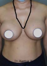 Breast Implants (Breast Augmentation)