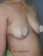 Breast Implants (Breast Augmentation)