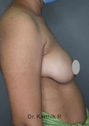 Breast Implants (Breast Augmentation)