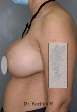 Breast Implants (Breast Augmentation)