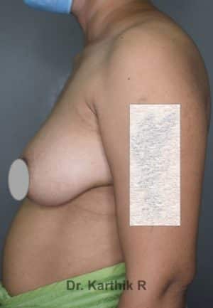 Breast Implants (Breast Augmentation)