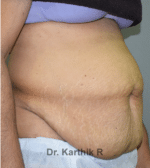 Tummy Tuck