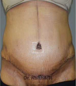 Tummy Tuck