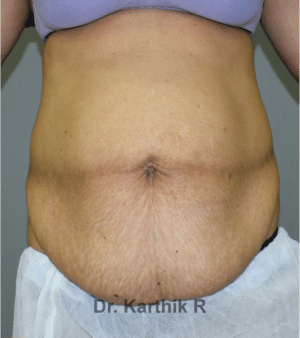 Tummy Tuck