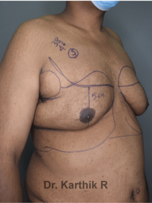 Gynecomastia (Puffy Nipples/ Male Chest Correction)