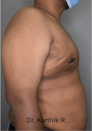 Gynecomastia (Puffy Nipples/ Male Chest Correction)