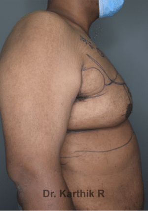 Gynecomastia (Puffy Nipples/ Male Chest Correction)