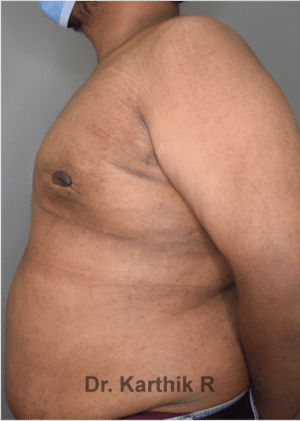Gynecomastia (Puffy Nipples/ Male Chest Correction)