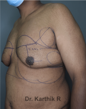 Gynecomastia (Puffy Nipples/ Male Chest Correction)
