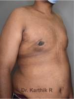 Gynecomastia (Puffy Nipples/ Male Chest Correction)