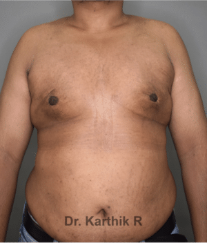 Gynecomastia (Puffy Nipples/ Male Chest Correction)