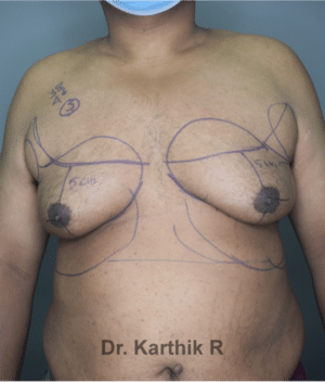 Gynecomastia (Puffy Nipples/ Male Chest Correction)
