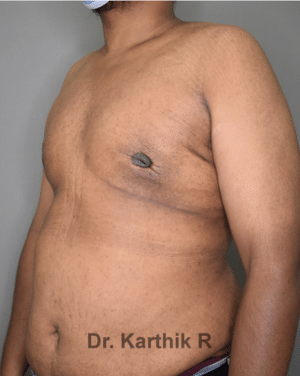 Gynecomastia (Puffy Nipples/ Male Chest Correction)