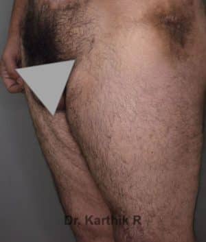 Thigh Lift