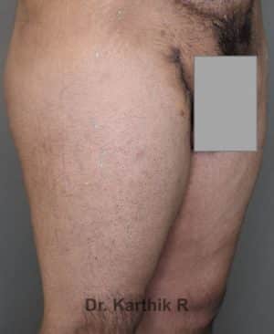 Thigh Lift