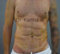 Abdominal Etching