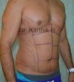 Abdominal Etching