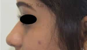 Dermal Fillers