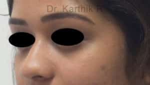 Dermal Fillers