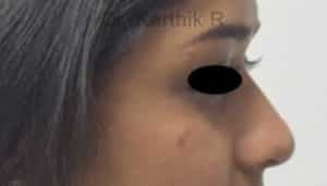 Dermal Fillers