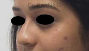 Dermal Fillers