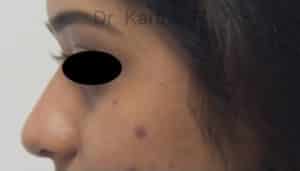 Dermal Fillers