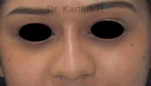 Dermal Fillers