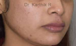 Dermal Fillers