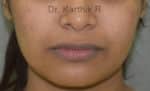 Dermal Fillers