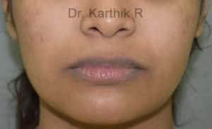 Dermal Fillers