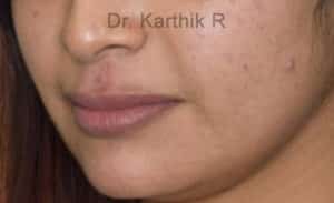 Dermal Fillers