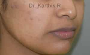 Dermal Fillers