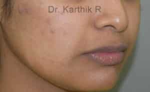 Dermal Fillers