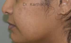 Dermal Fillers