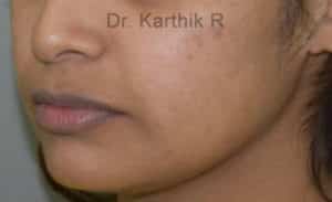 Dermal Fillers