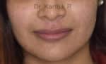 Dermal Fillers