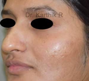 Dermal Fillers