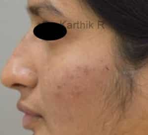 Dermal Fillers