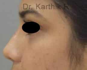 Dermal Fillers