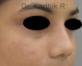 Dermal Fillers