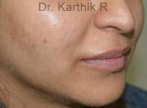 Dermal Fillers