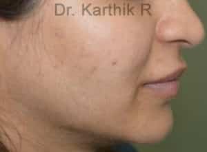 Dermal Fillers