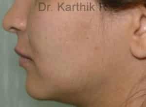 Dermal Fillers