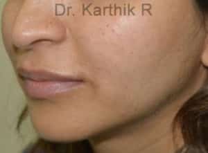 Dermal Fillers