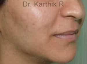 Dermal Fillers