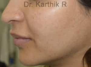 Dermal Fillers