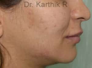 Dermal Fillers