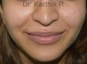 Dermal Fillers