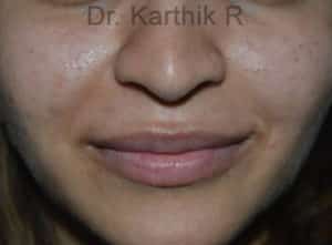 Dermal Fillers