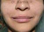 Dermal Fillers